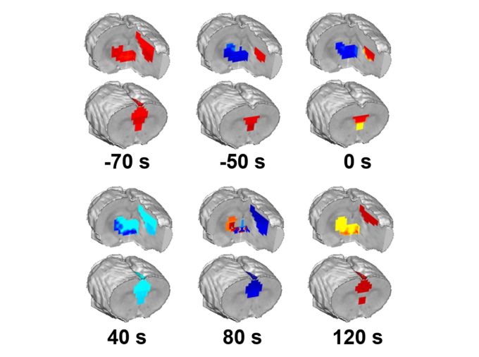 <p>The shift from an awake state to unconsciousness is a phenomenon that has long captured the interest of scientists and philosophers alike, but how it happens has remained a mystery — until now. Through studies on rats, a team of researchers at Penn State has pinpointed the exact moment of loss of consciousness due to anesthesia, mapping what happens in different brain regions during that moment.</p>